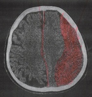 Hirnblutung/chronisches Subduralhämatom - die Neurochirurgie ist präpotent und die Neurologie naiv. Teil 1