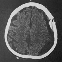 Hirnblutung/chronisches Subduralhämatom - die Neurochirurgen sind leider nicht nur präpotent und die Neurologen wider besseren Wissenmüssens naiv. Teil 4